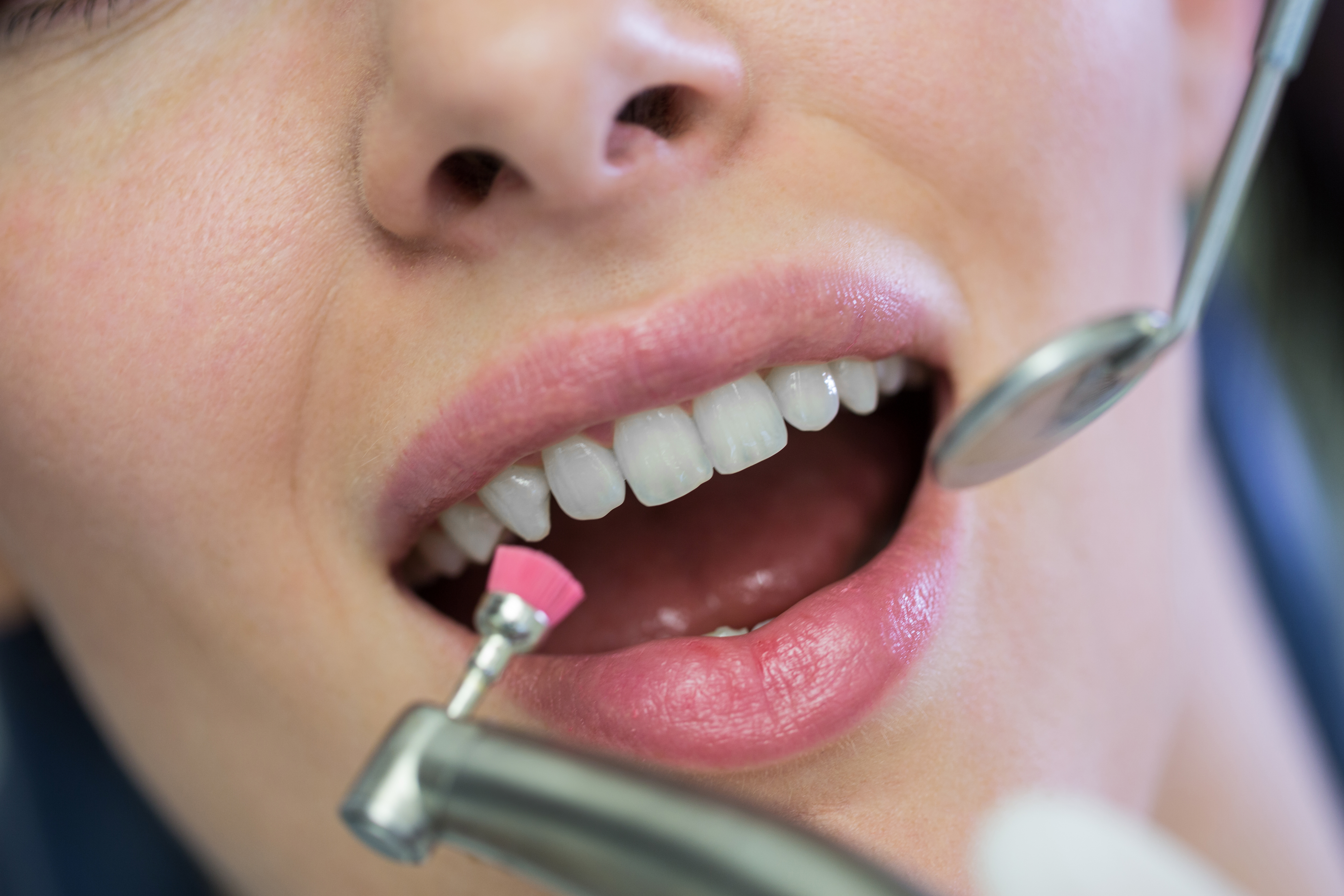 cost of veneers in dallas tx