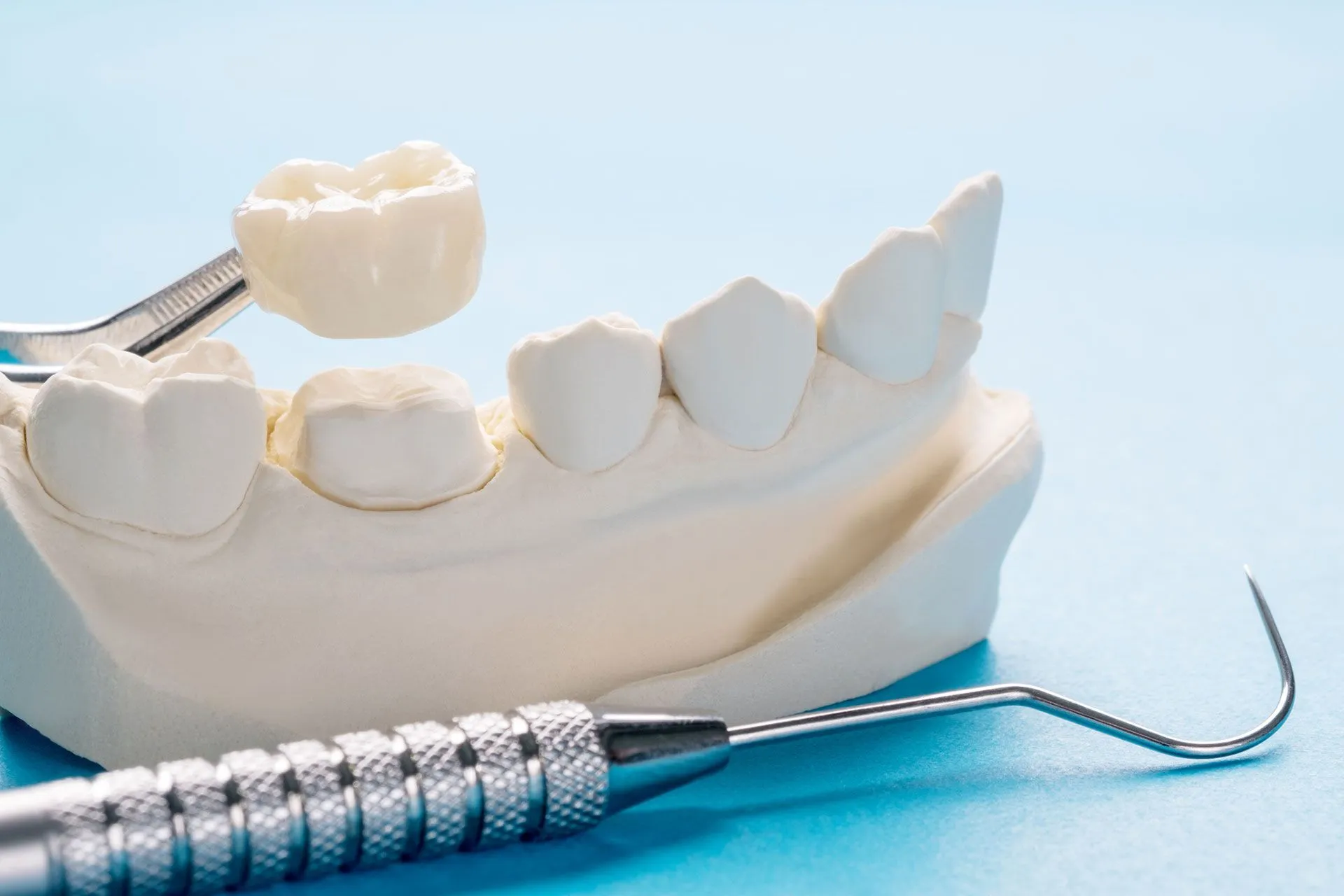 Dental crowns in dallas