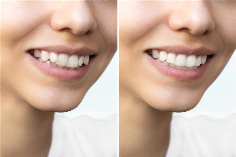 clear aligners before and after