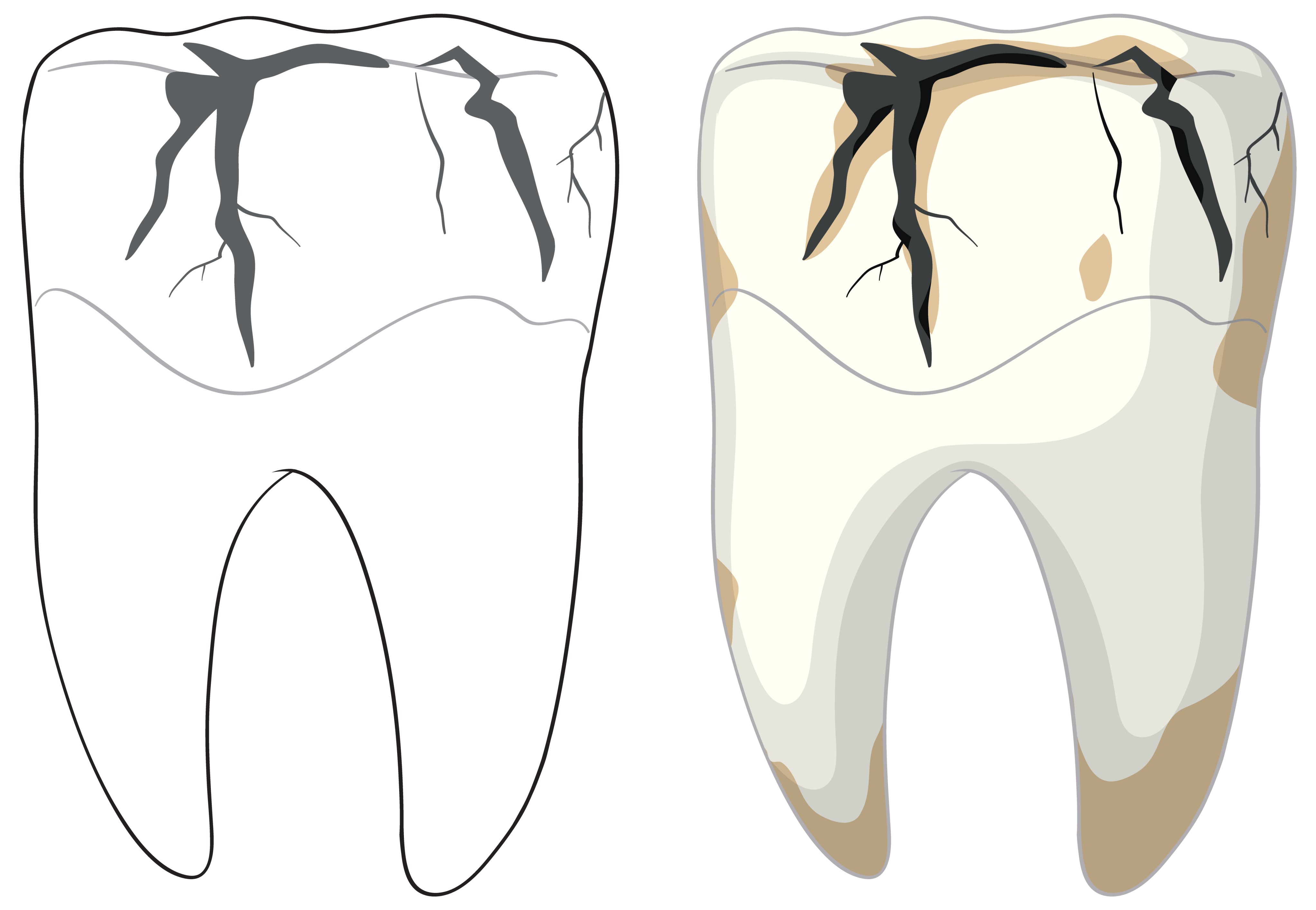 Cracked tooth treatment dallas