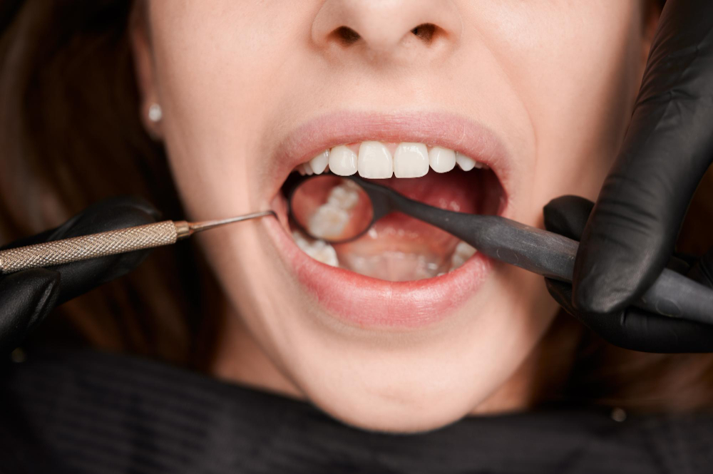 Wisdom Teeth Removal Dallas