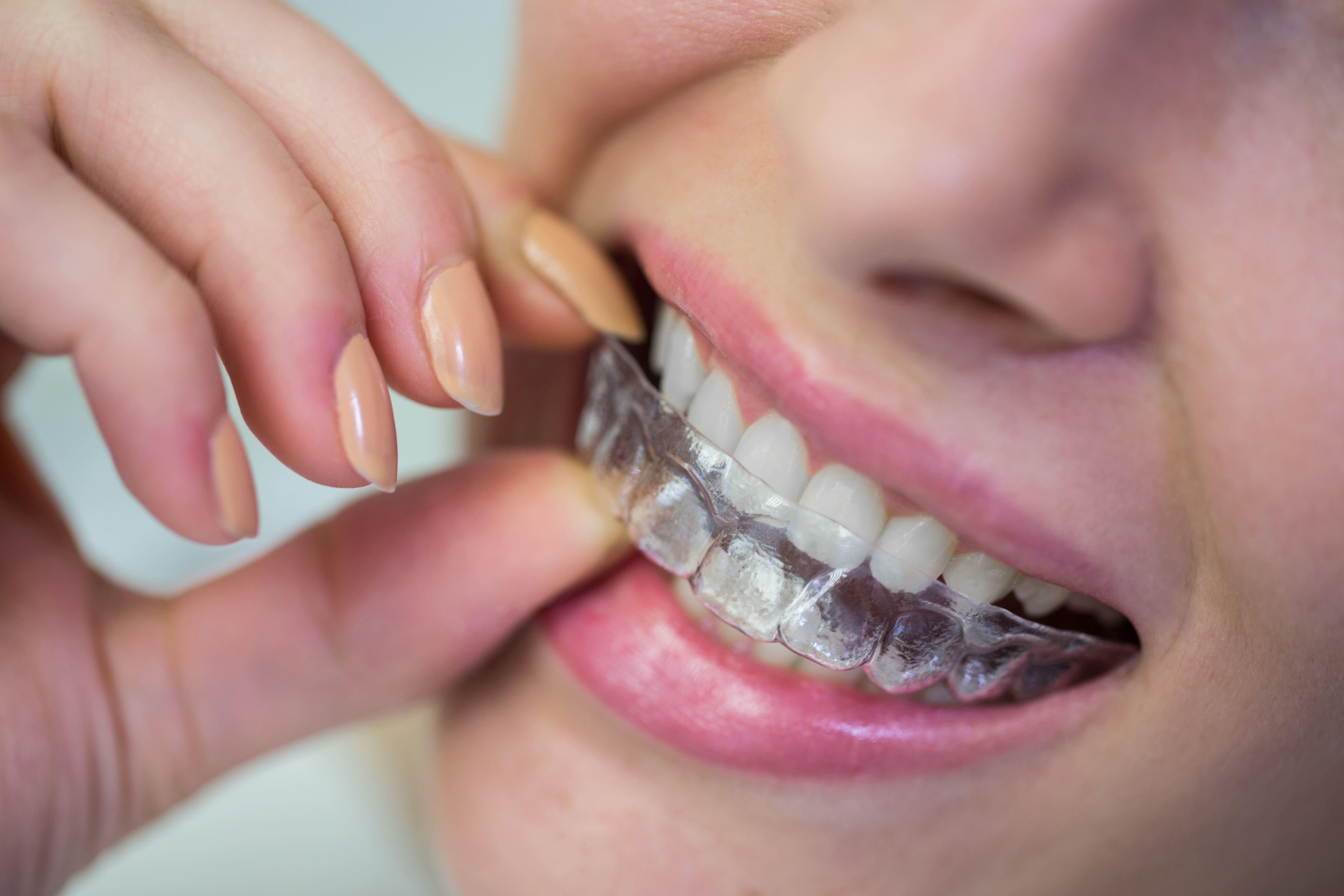 Invisalign Clear aligners